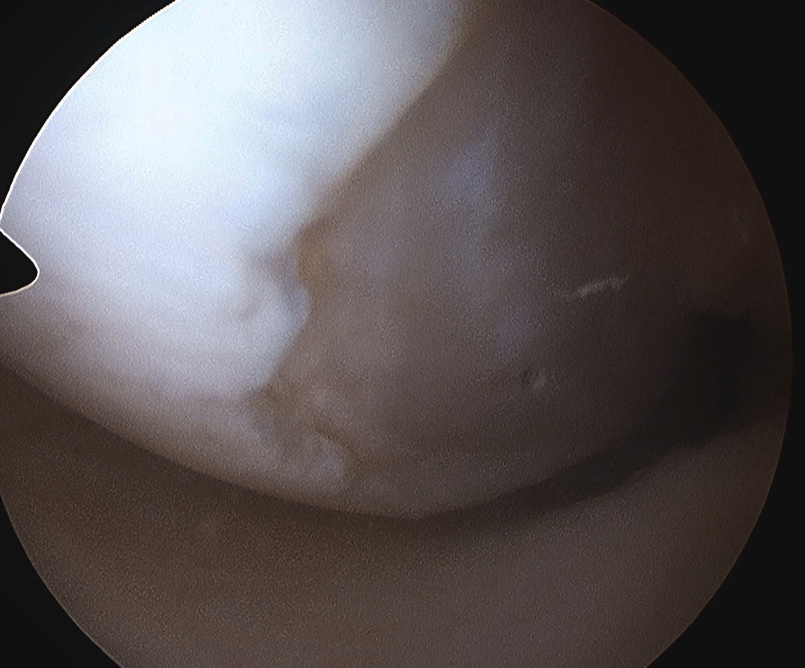 Chondral Defect Medial Femoral Condyle